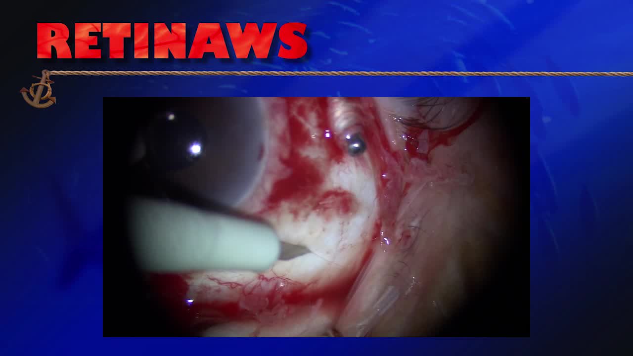 Suprachoroidal Hemorrhage