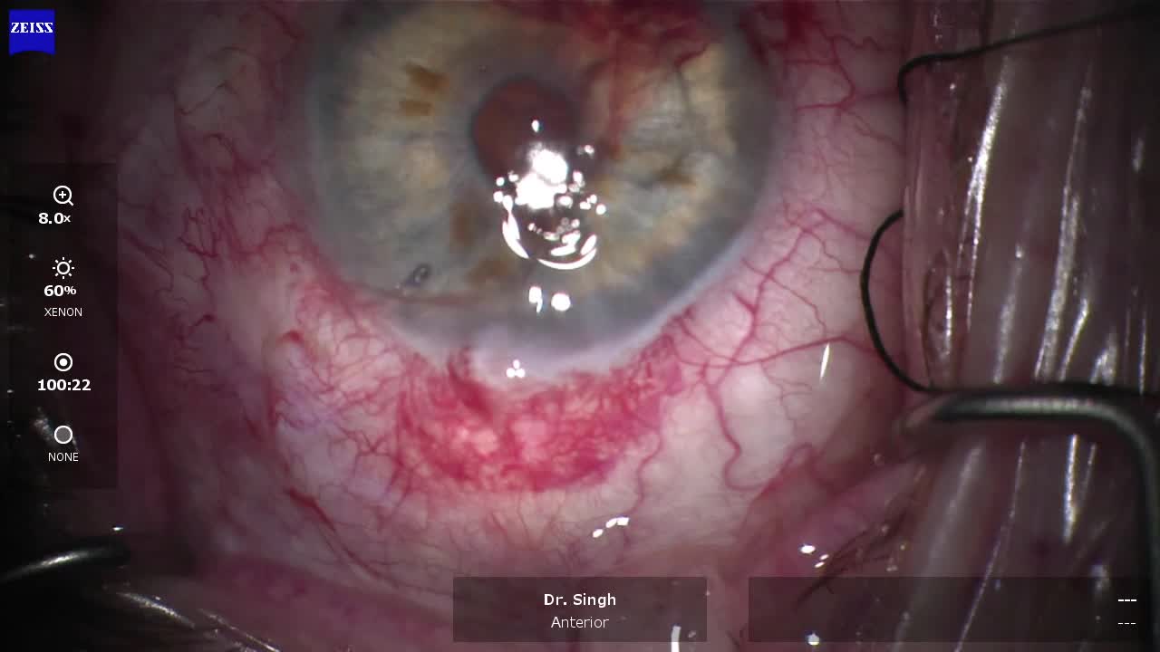 180-Degree Otomy With the iTrack Catheter