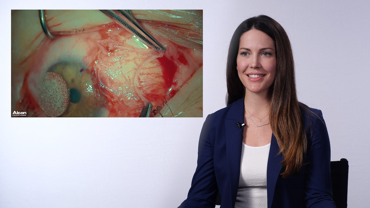 Progressive Pterygium Removal with 3-D Visualization