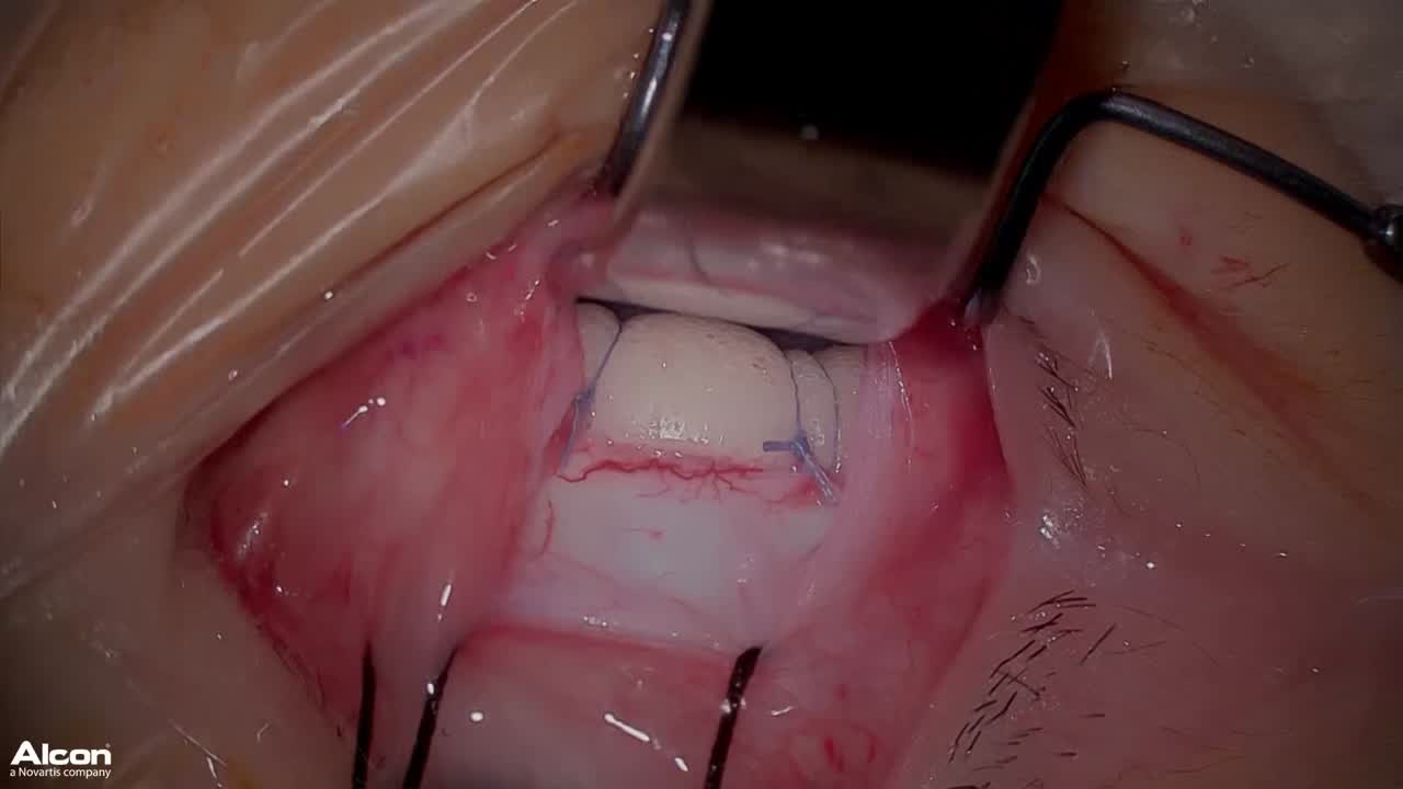 Scleral Buckling