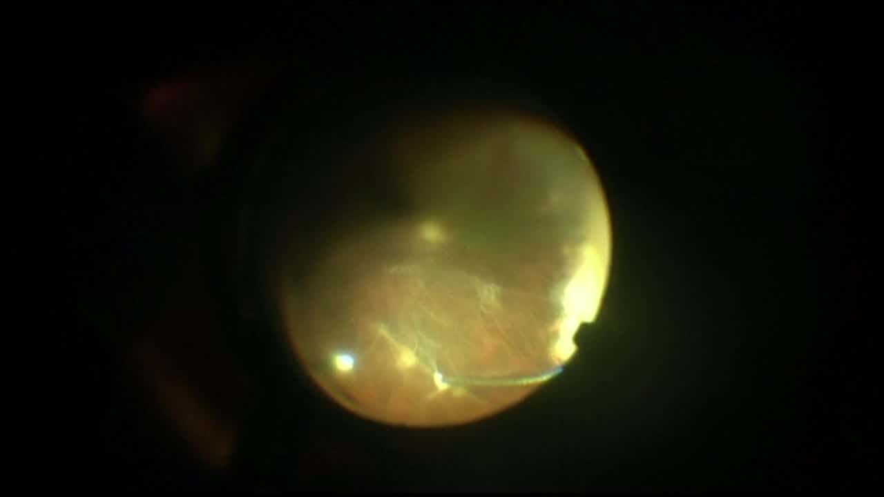 Subretinal Band Removal