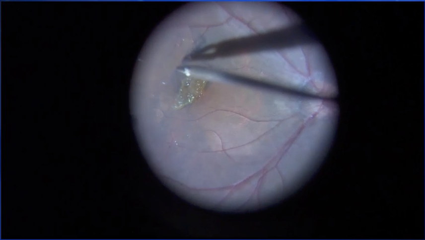 Lamellar Macular Hole