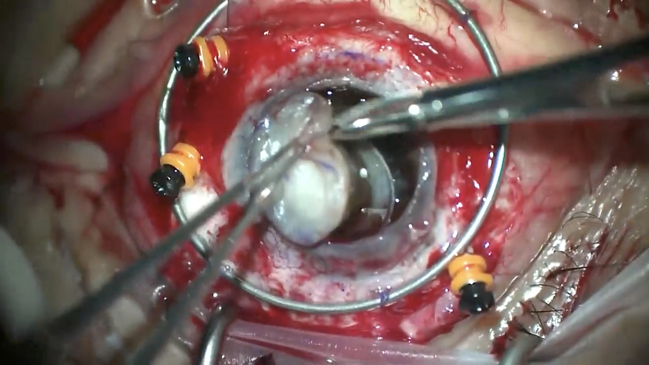 Endophthalmitis