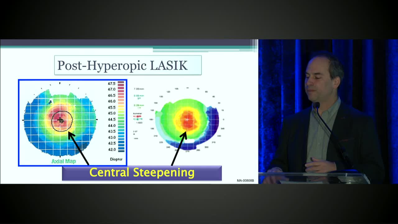 How I Diagnose Keratoconus and Monitor Progression