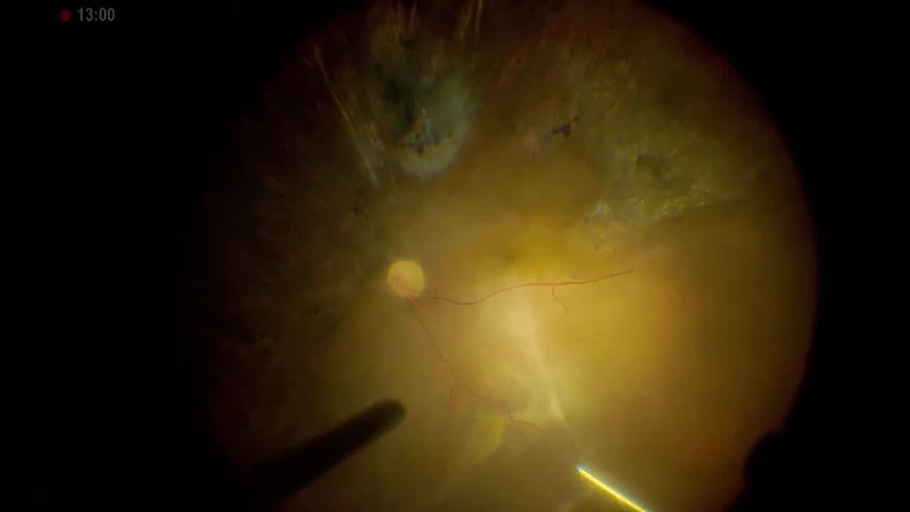 Subretinal Peeling