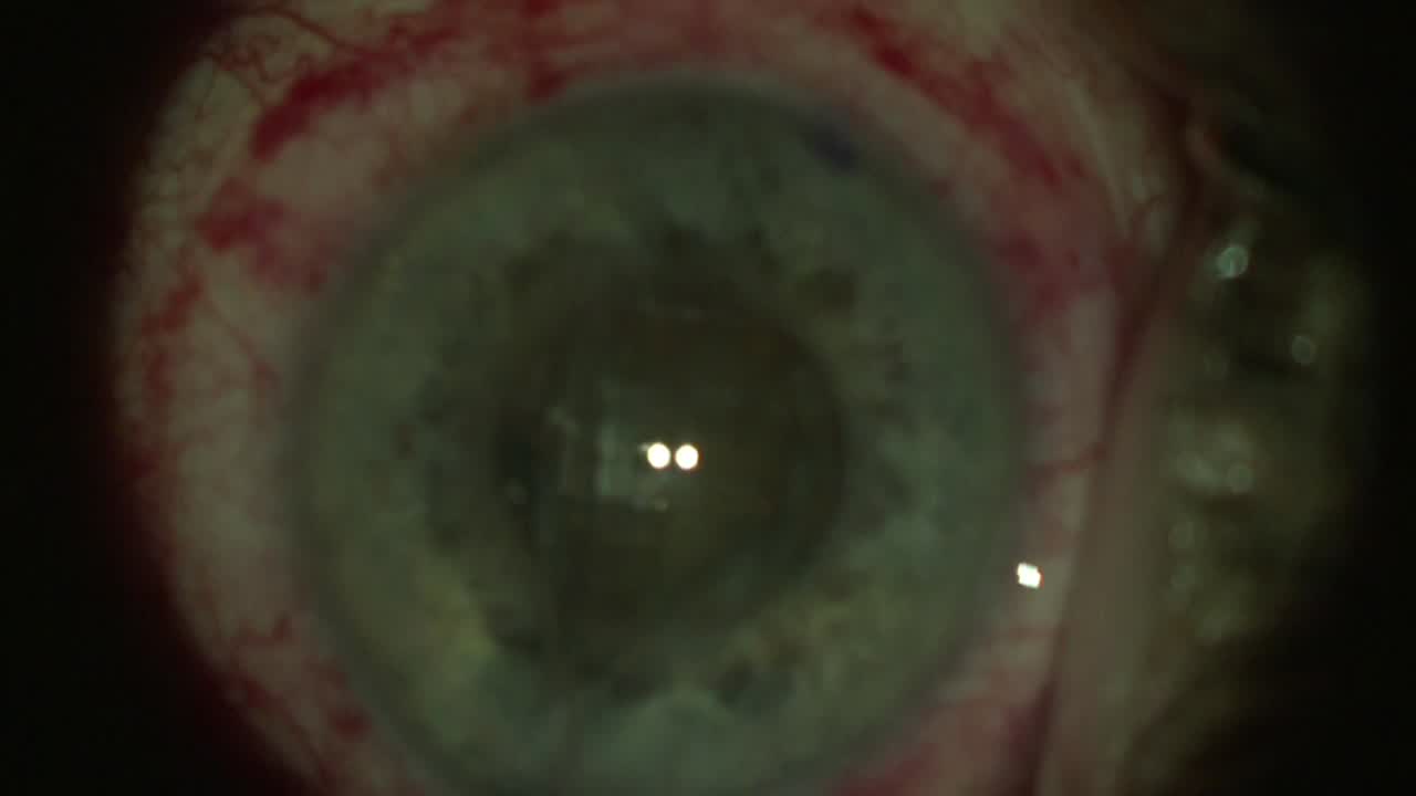Small Pupil Zonulopathy