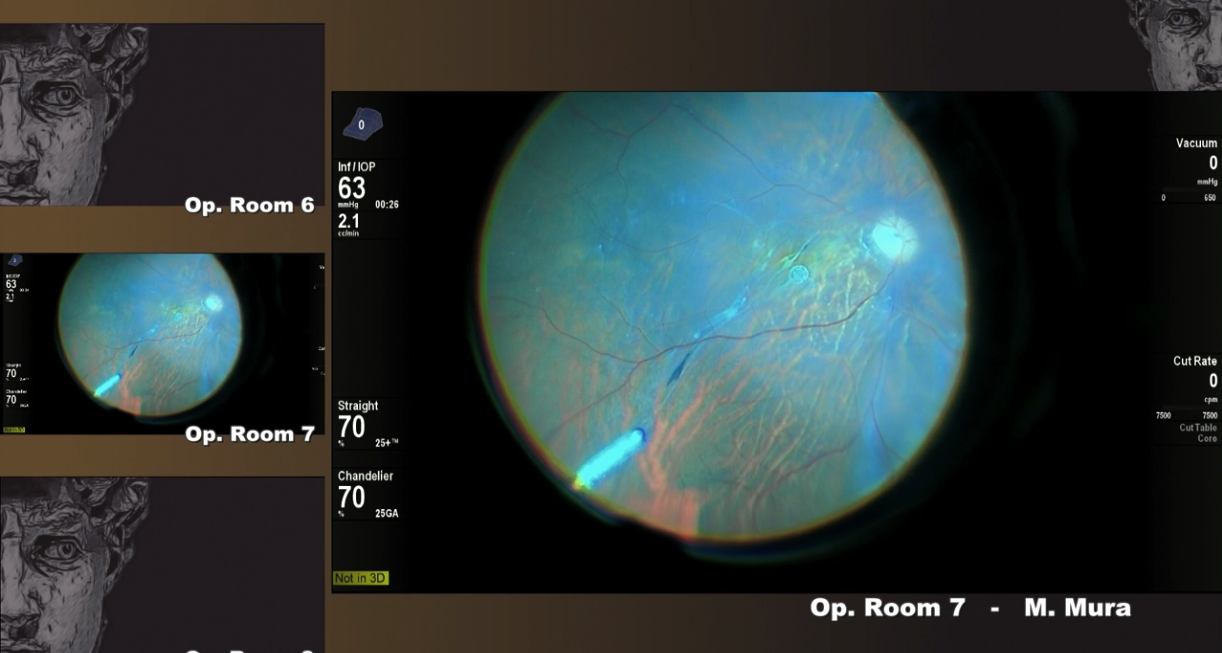 [3-D] Bimanual Surgery for Complicated Diabetic Retinal Detachment and Vitreous Hemorrhage