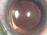 Explantation of a Multifocal IOL Using the MST IOL Cutter