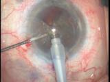 Posterior Capsular Tear in an Eye With Previous Silicone Oil Tamponade