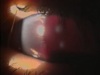 Hyphema Resolution