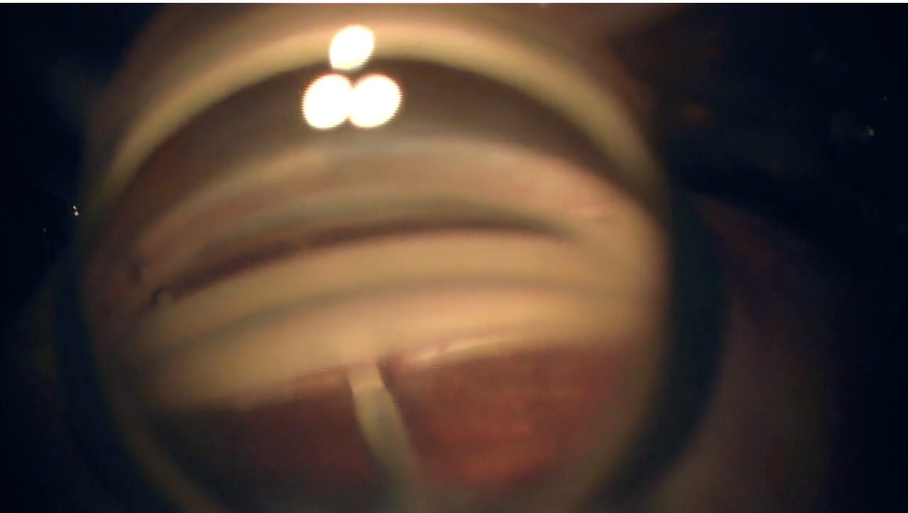 Kahook Dual Blade goniotomy