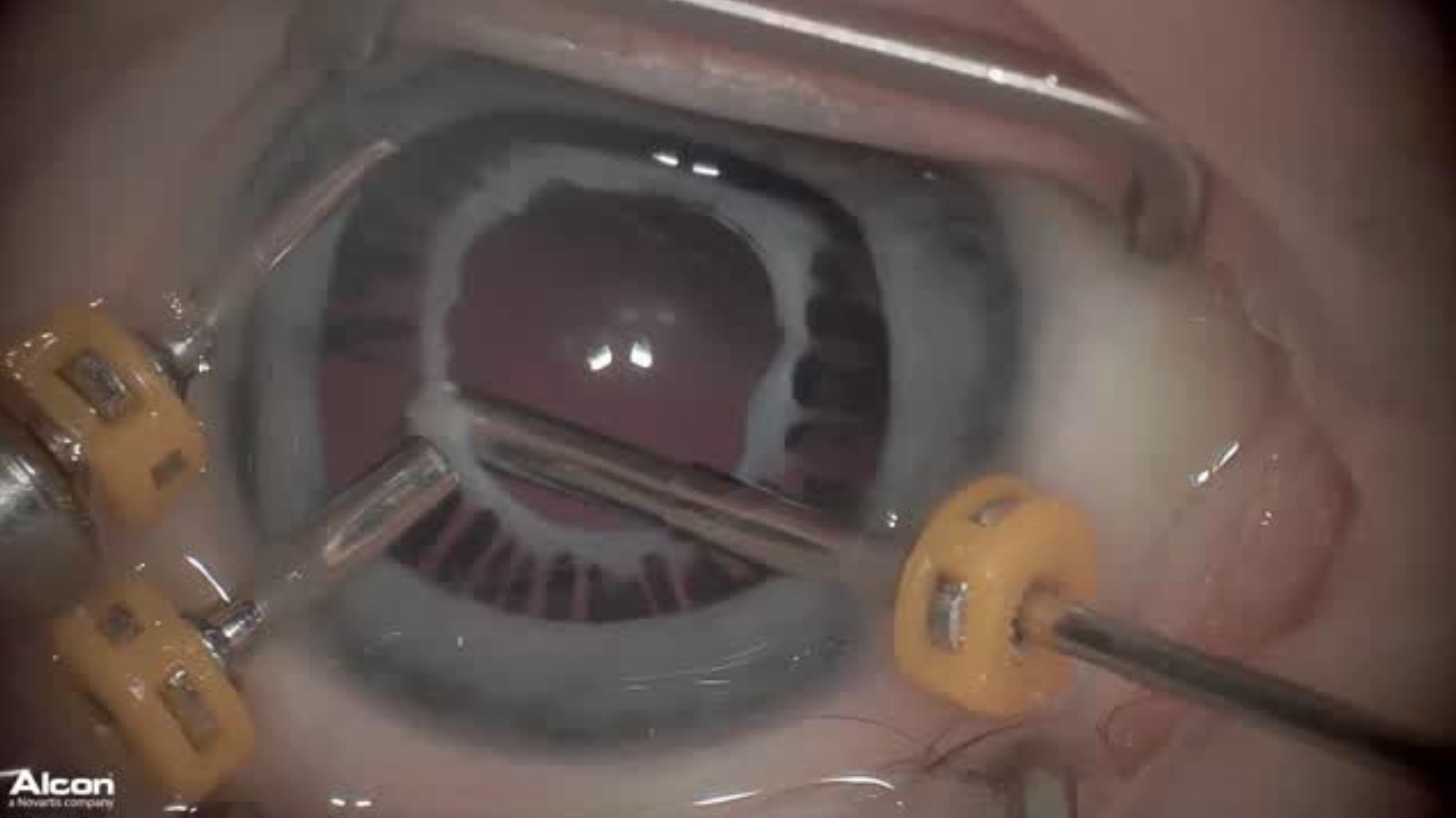 23-Gauge Plaque Dissection of Anterior Persistent Fetal Vasculature in a 2-week-old Boy