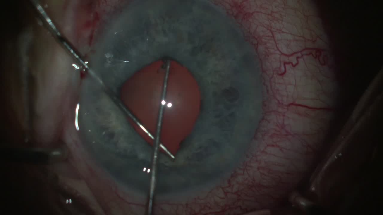 C.M. McCabe, MD | EyeJet<sup>®</sup> Type 15 Preloaded CTR | Small Pupil with PS and Loose Capsular Bag