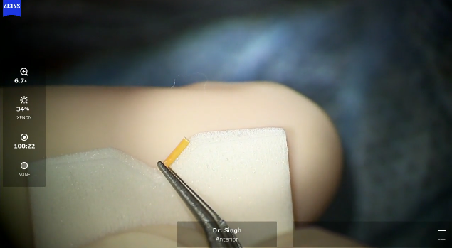 Using Packaging With Dextenza