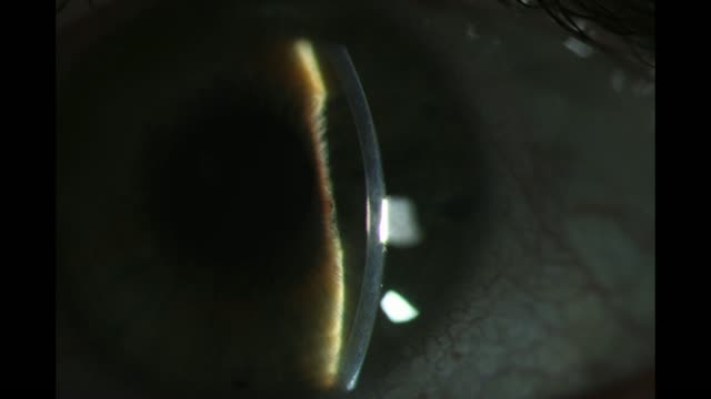 Phacomorphic Glaucoma With Peripheral Iridotomies