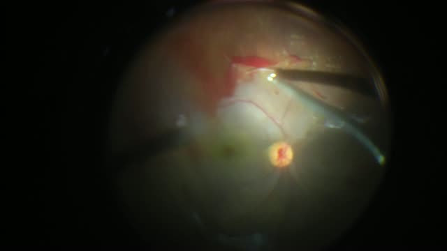 Reoperation for Incomplete Hyaloid Removal After Initial Diabetic Vitrectomy