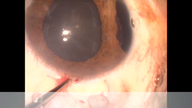 Iris Repair, Trabeculectomy, and Phacoemulsification