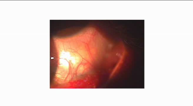 Scleral Staphyloma