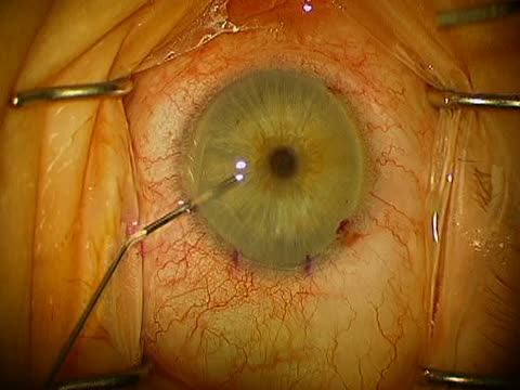 DMEK Democratized (Iowa Eyebank pre-stripped graft/Jones tube injector/SF6 tamponade)
