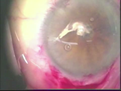 Pearls for Vitreous Traction Avoidance and Unplanned Vitrectomy Strategy
