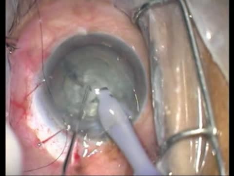 Carbon Dioxide Assisted Sclerectomy Surgery (CLASS)