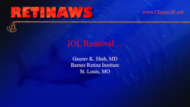IOL Removal