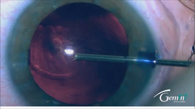 Implantation of a Trifocal Extended-Depth-of-Focus IOL