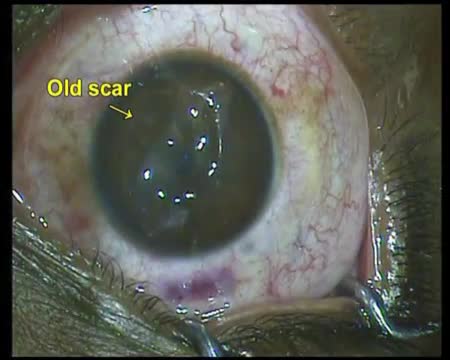 Longest Refractive Day