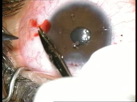 Scleral Fixation of Plate-Haptic Lens in Absence of Capsular Support