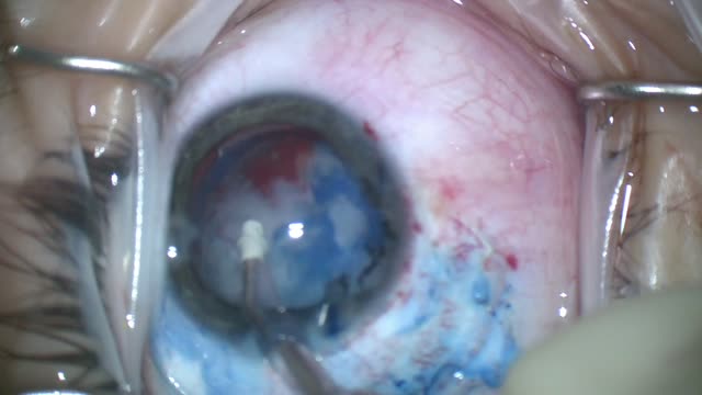 Traumatic Cataract, Pupilloplasty, McCannel Suture