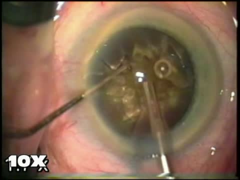Brunescent Circumferential Disassembly