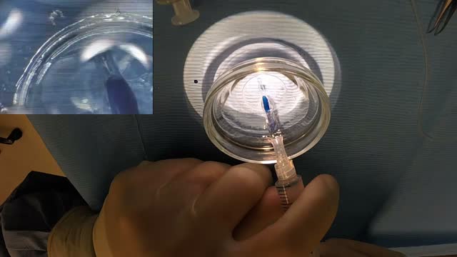 Jones Tube for DMEK: GoPro Wide View of Injector Prep and Graft Loading