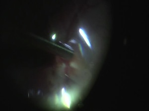 Surgical Management of Pediatric Macular Hole