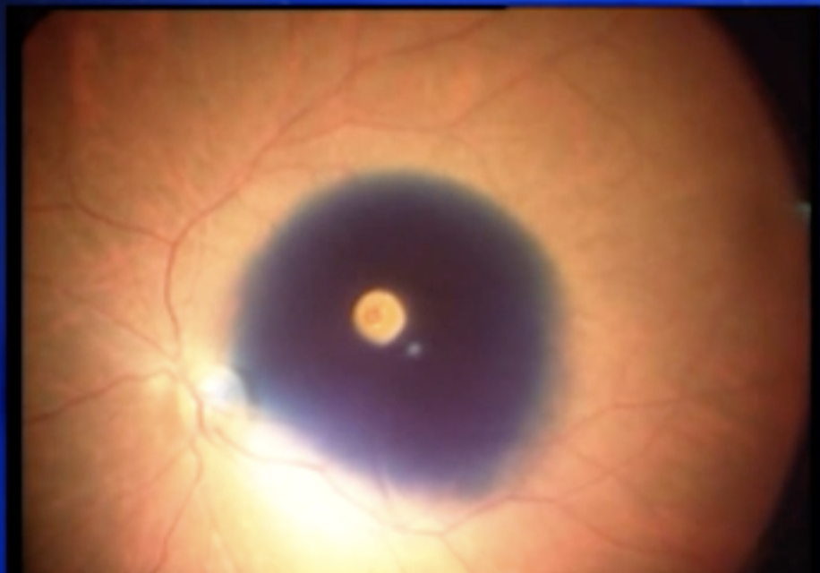 Macular Hole & Perfluoron
