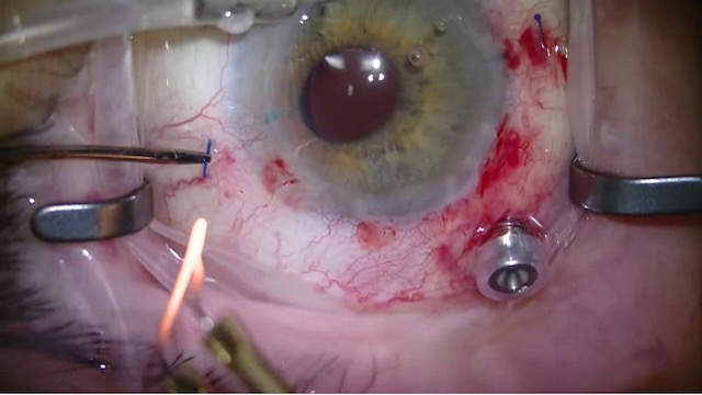 IOL Exchange and Fixation via Haptic Deformation