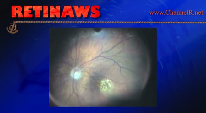 Macular Hole