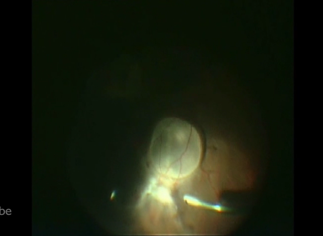 Cysticercosis