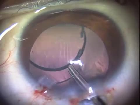 Double Optic Capture using a Purposeful PCCC