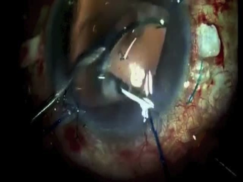 Subluxated Capsular-Bag Complex with Endocapsular Ring and Dislocated Segment
