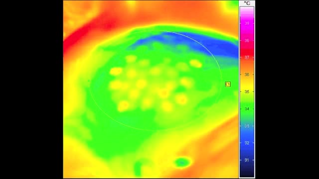 One-Step Transepithelial Photorefractive Keratectomy