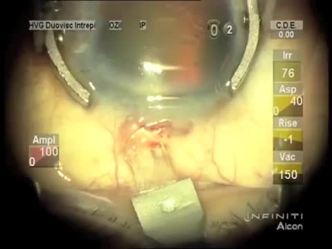 Cataract Incision with a Pterygium