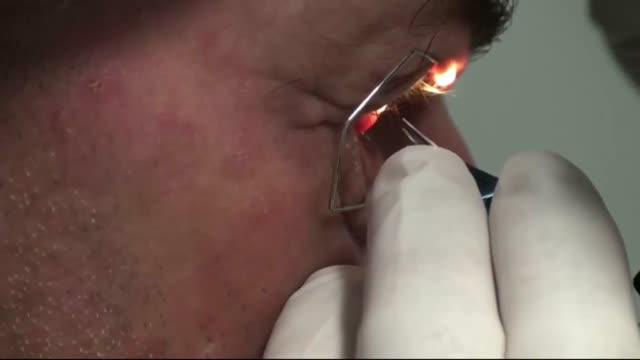 How to Perform a Corneal Biopsy
