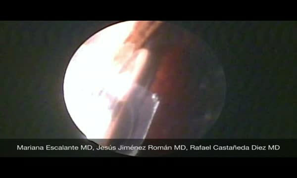 Phacoemulsification View from Inside Anterior Chamber