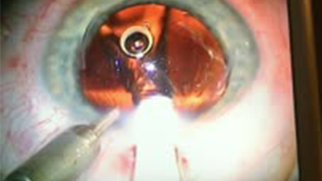Lens Insertion Without Viscoelastic