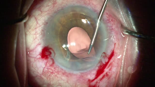 Corectopia After ACIOL