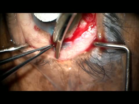 Hydrogel Sealant to Prevent Chamber Shallowing During Combined Phaco and Tube Shunt Insertion