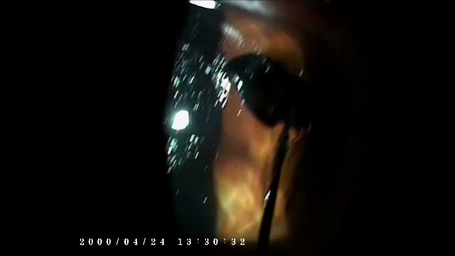 KAMRA Removal at the Slit Lamp
