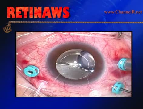 Multifocal IOL