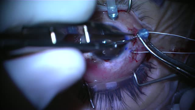 27Ga Scleral Fixation of Akreos Lens with Gore-Tex Suture