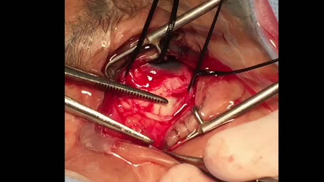 Orbital Fat Extrusion During Scleral Buckling